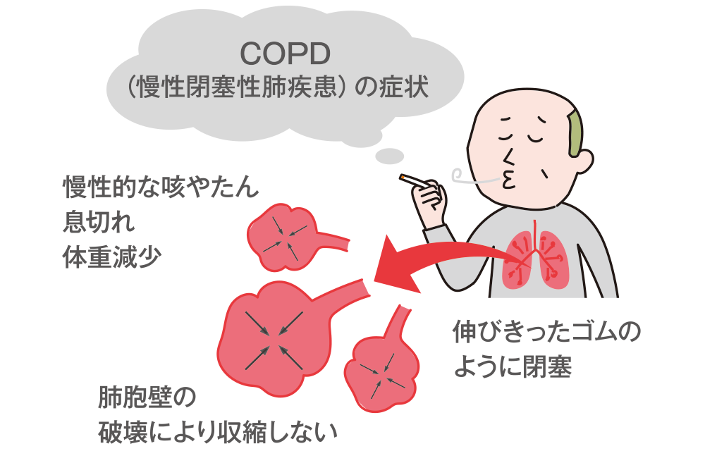 図：COPD（慢性閉塞性肺疾患）の症状